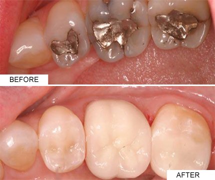 Tooth Coloured Fillings Restoration